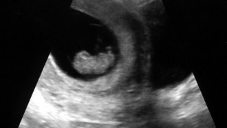 Week 9 Ultrasound - That Poore Baby