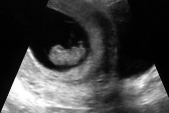 Week 9 Ultrasound - That Poore Baby