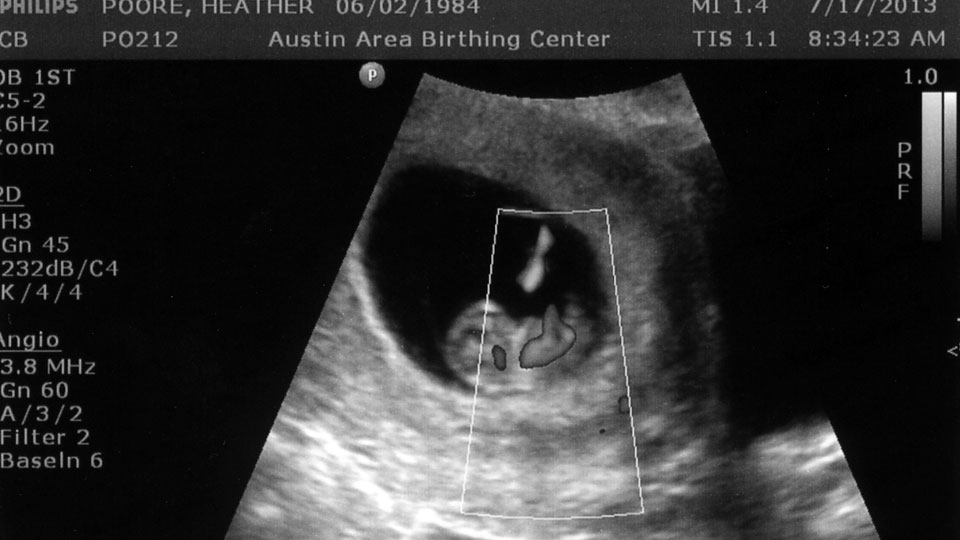 Week 9 Ultrasound Heat Scan - That Poore Baby